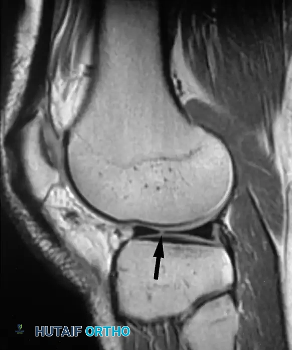 صورة رنين مغناطيسي تظهر تمزق شعاعي في الحافة الحرة للغضروف الهلالي الخارجي