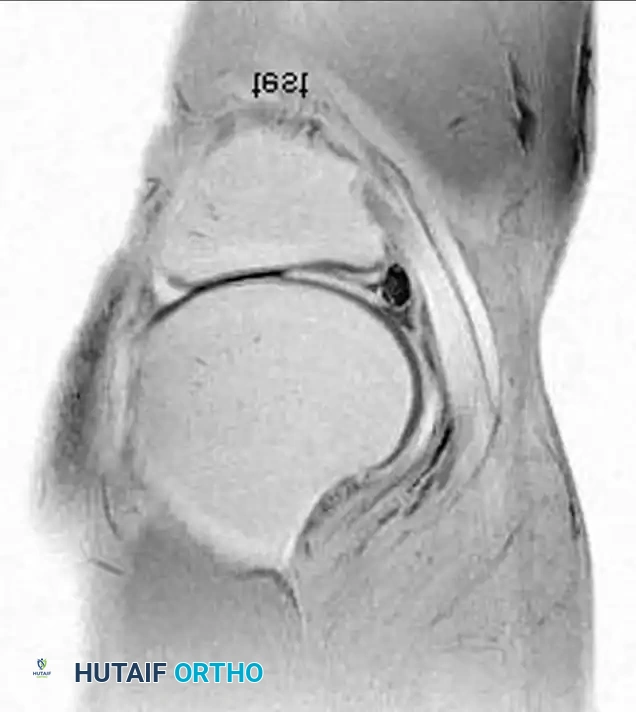 صورة رنين مغناطيسي تظهر كيس غضروفي كبير بجوار الغضروف الهلالي الداخلي