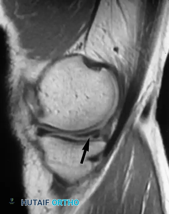 صورة رنين مغناطيسي توضح تمزق مائل في القرن الخلفي للغضروف الهلالي الداخلي