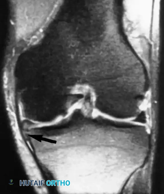 صورة رنين مغناطيسي تظهر جزء من الغضروف الداخلي مزاح للأسفل تحت الرباط الجانبي