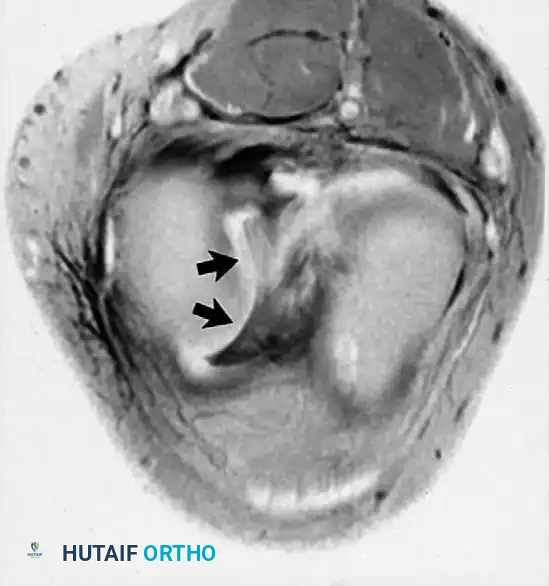 صورة رنين مغناطيسي محورية تؤكد انزياح الجزء الممزق من الغضروف الداخلي