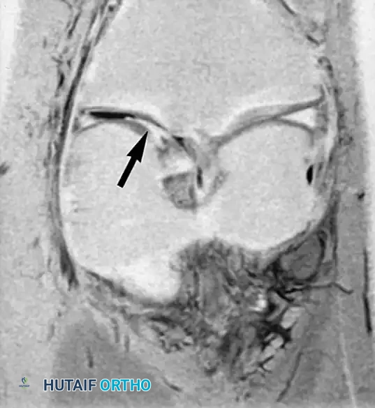 صورة رنين مغناطيسي إكليلية توضح تمزق يد الدلو وانزياح الغضروف للداخل