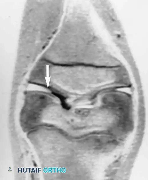 صورة رنين مغناطيسي إكليلية توضح امتداد الغضروف القرصي داخل المفصل