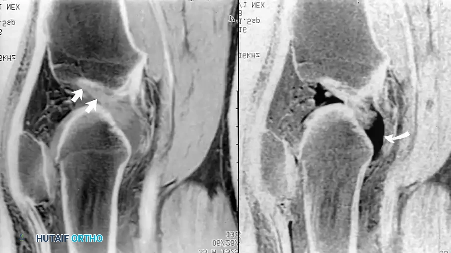 صورة رنين مغناطيسي تظهر الاتجاه الأفقي غير الطبيعي للرباط الصليبي الممزق