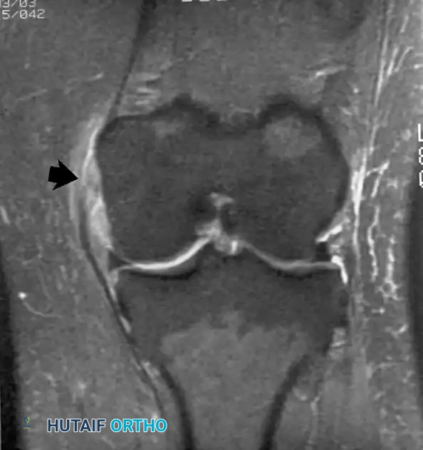 صورة رنين مغناطيسي تؤكد سلامة الأربطة المتعددة في الركبة للتقييم قبل الجراحة