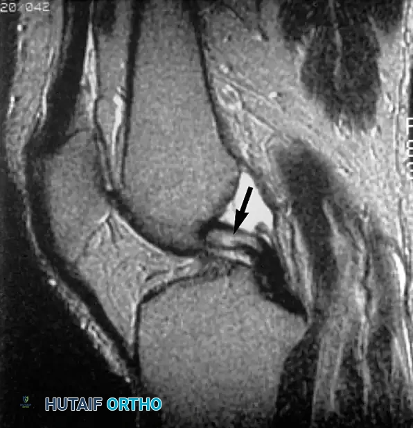 صورة رنين مغناطيسي تظهر تجمع السوائل في موقع انفصال الرباط من عظمة الفخذ