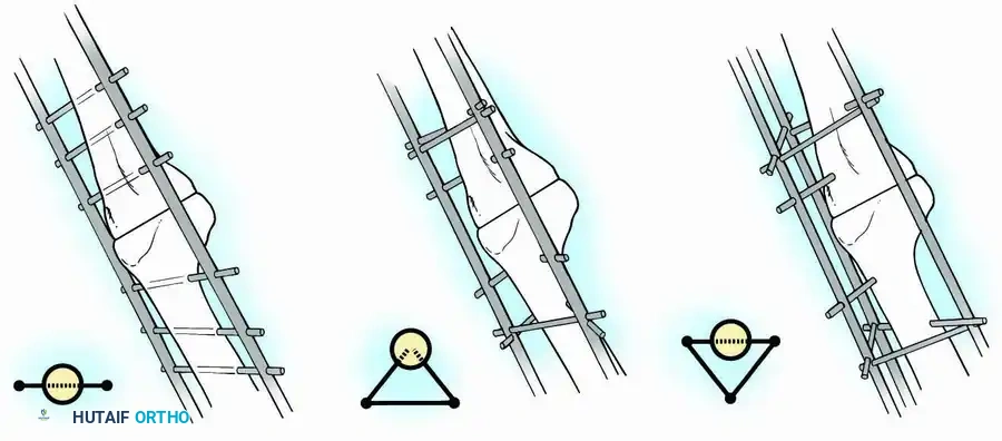 External Fixator Configurations