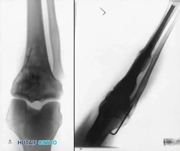 IM Nail X-Ray Results