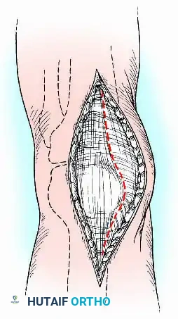 Anterior Longitudinal Incision