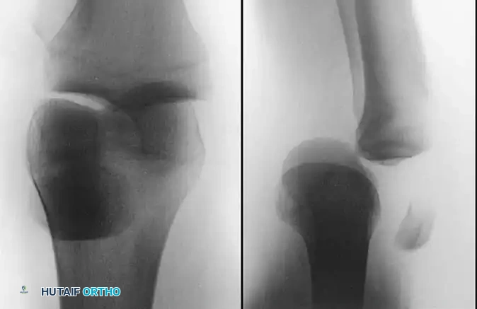 Operative Management of Knee and Proximal Tibiofibular Joint Dislocations
