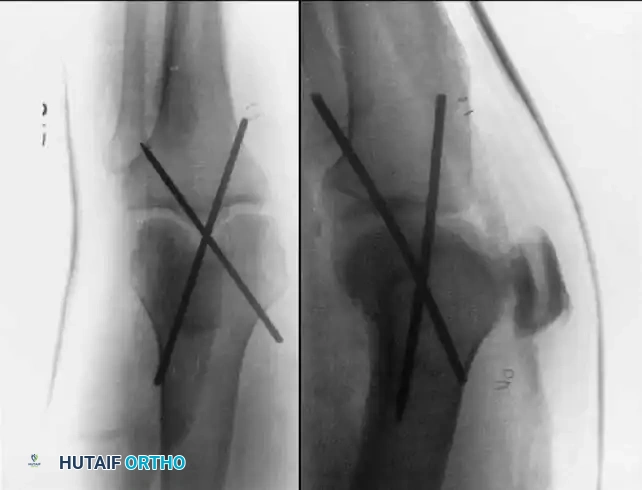 KNEE Surgical Diagram