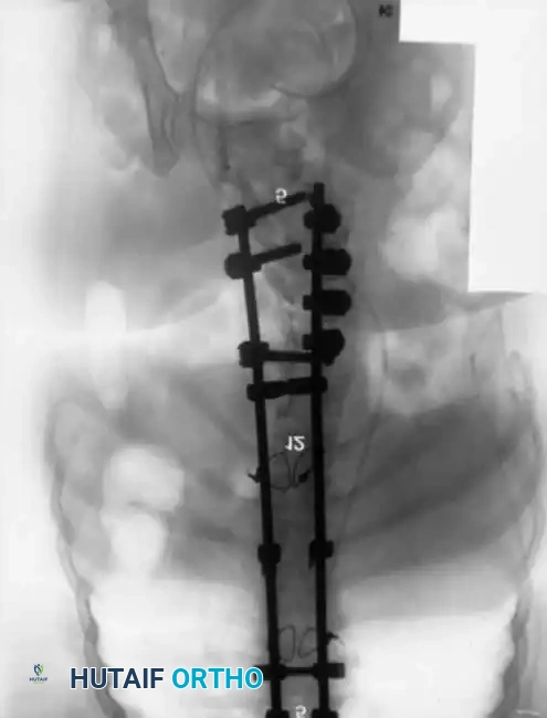 KYPHOSCOLIOSIS Surgical Diagram