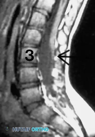 Fig. 38-188 MRI shows tethered cord at L3 in patient with kyphoscoliosis.