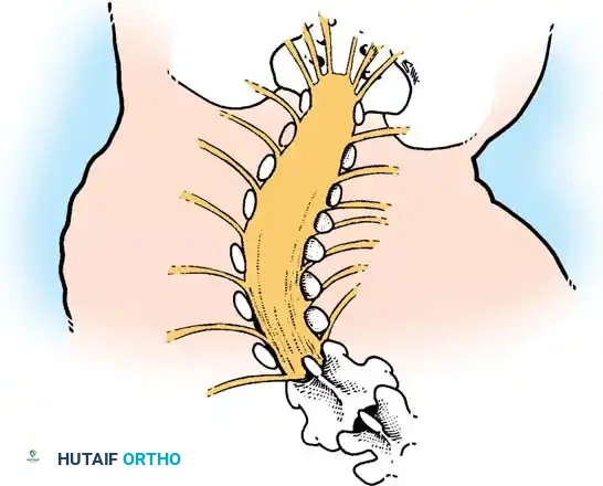 KYPHOSCOLIOSIS Surgical Diagram