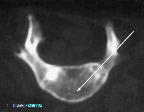 KYPHOSCOLIOSIS Surgical Diagram