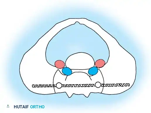 KYPHOSCOLIOSIS Surgical Diagram