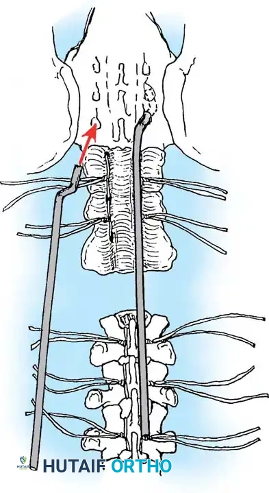 KYPHOSCOLIOSIS Surgical Diagram