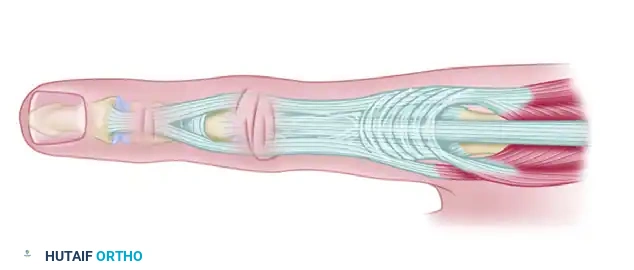 Surgical Management of Rheumatoid Extensor Mechanism Deformities: Lateral Band Mobilization and Boutonnière Correction