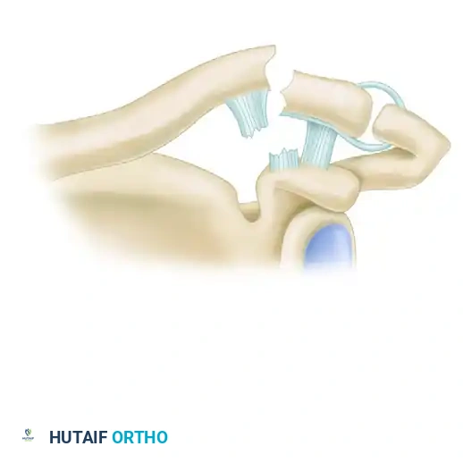 LATERAL CLAVICULAR FRACTURES Surgical Diagram