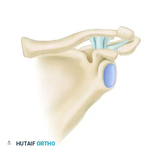 LATERAL CLAVICULAR FRACTURES Surgical Diagram