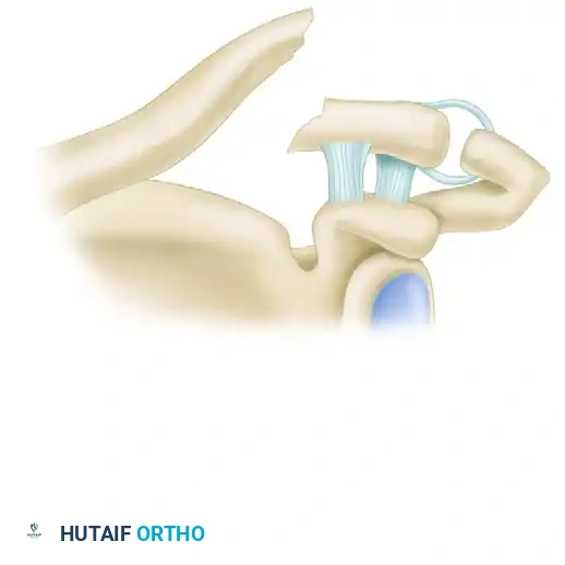 LATERAL CLAVICULAR FRACTURES Surgical Diagram
