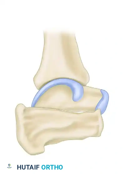 Lateral Impingement Anatomy