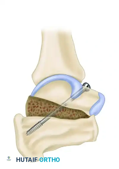 Subtalar Distraction Bone Block Arthrodesis