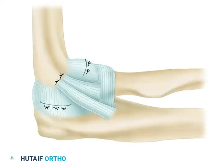 LATERAL ULNAR COLLATERAL LIGAMENT RECONSTRUCTION FOR POSTEROLATERAL ROTATORY INSTABILITY Surgical Diagram