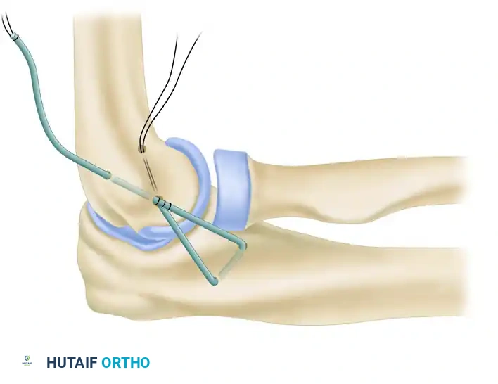 LATERAL ULNAR COLLATERAL LIGAMENT RECONSTRUCTION FOR POSTEROLATERAL ROTATORY INSTABILITY Surgical Diagram