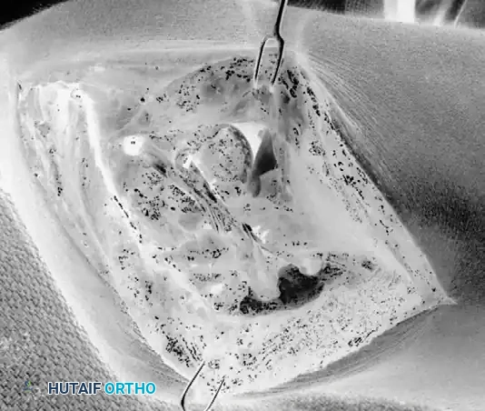 LATERAL ULNAR COLLATERAL LIGAMENT RECONSTRUCTION FOR POSTEROLATERAL ROTATORY INSTABILITY Surgical Diagram