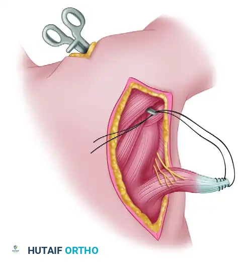 LATISSIMUS DORSI TRANSFER Surgical Diagram