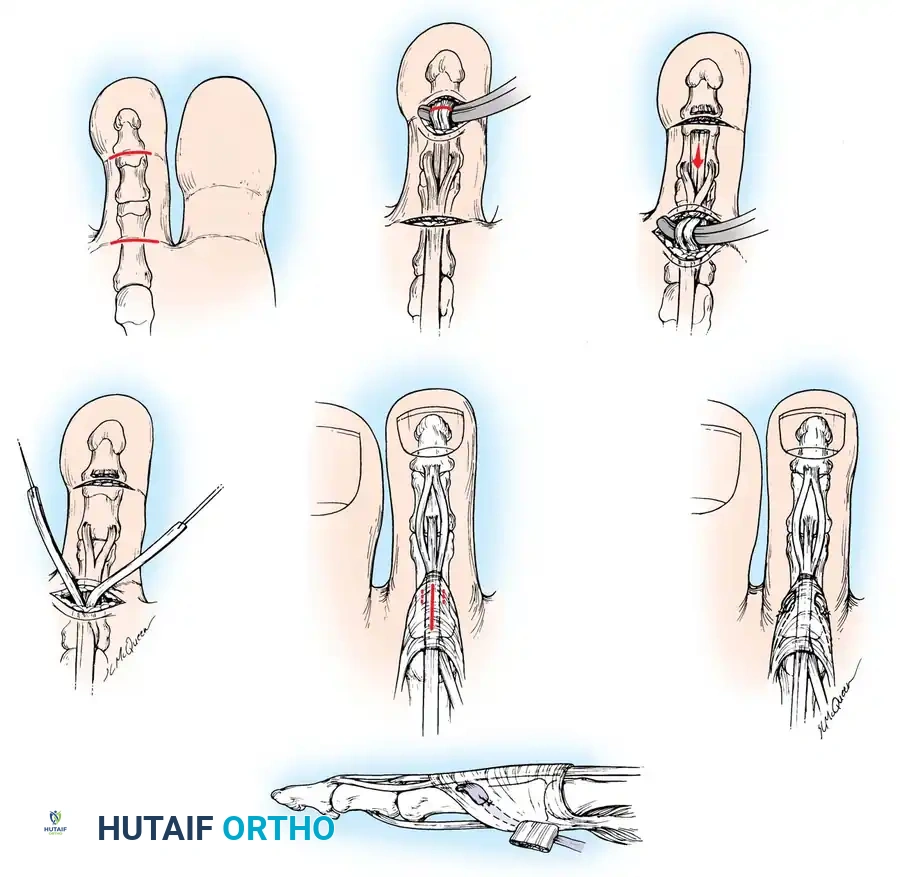 Incisions in extensor mechanism