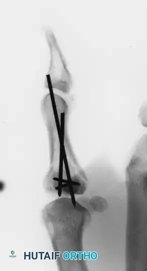 Direct Joint Inspection