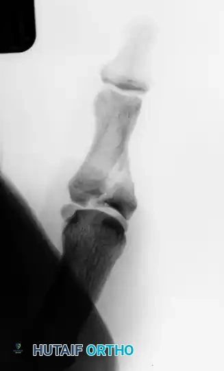 Preoperative AP X-ray