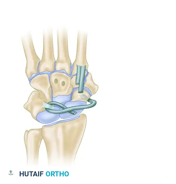 Carpal Ligament Reconstruction: Advanced Surgical Techniques