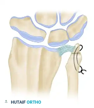 LIMITED ULNAR HEAD EXCISION: HEMIRESECTION INTERPOSITION ARTHROPLASTY Surgical Diagram