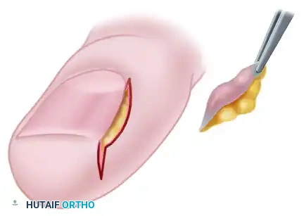 LONG-TERM FOLLOW-UP Surgical Diagram
