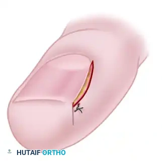LONG-TERM FOLLOW-UP Surgical Diagram