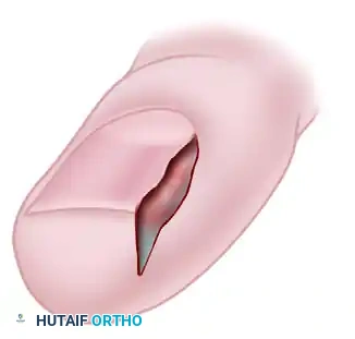 LONG-TERM FOLLOW-UP Surgical Diagram