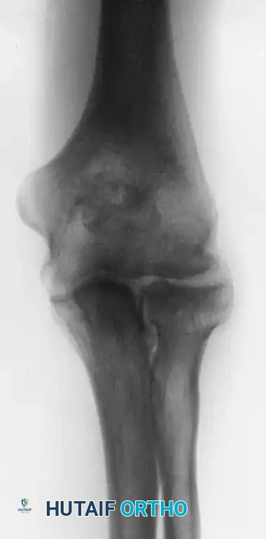 LOOSE BODIES Surgical Diagram