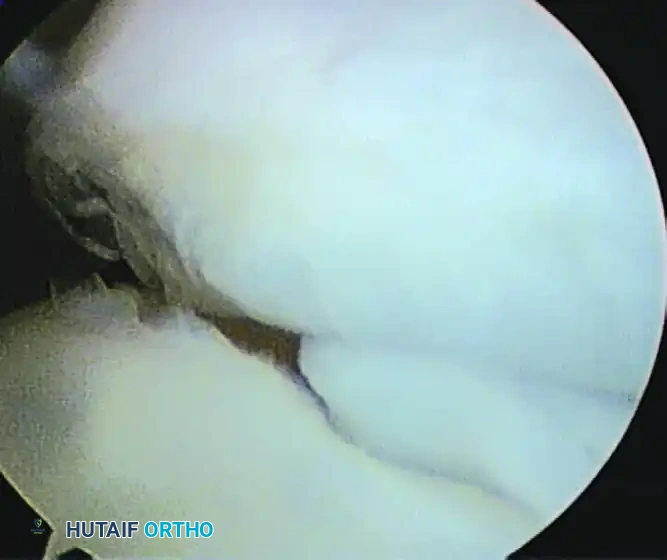 LOOSE BODIES Surgical Diagram