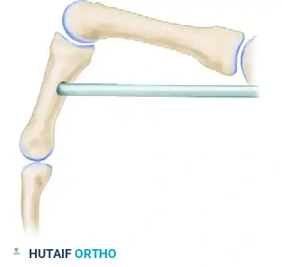 LOW MEDIAN NERVE PALSY Surgical Diagram