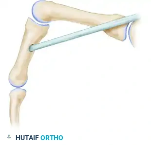 LOW MEDIAN NERVE PALSY Surgical Diagram