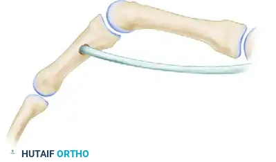 LOW MEDIAN NERVE PALSY Surgical Diagram