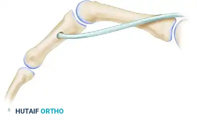 LOW MEDIAN NERVE PALSY Surgical Diagram