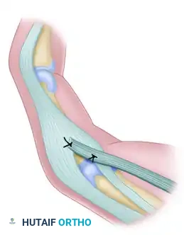 Surgical Management of Ulnar Nerve Palsy: Tendon Transfers and Functional Restoration