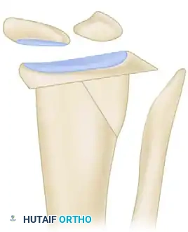 استخراج الجزء العظمي من الكعبرة لإعادة الهيكلة