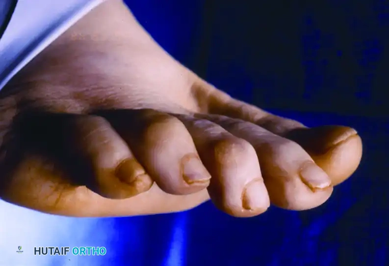 MALLET TOE Surgical Diagram