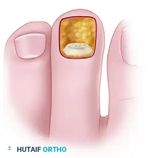 MALLET TOE Surgical Diagram