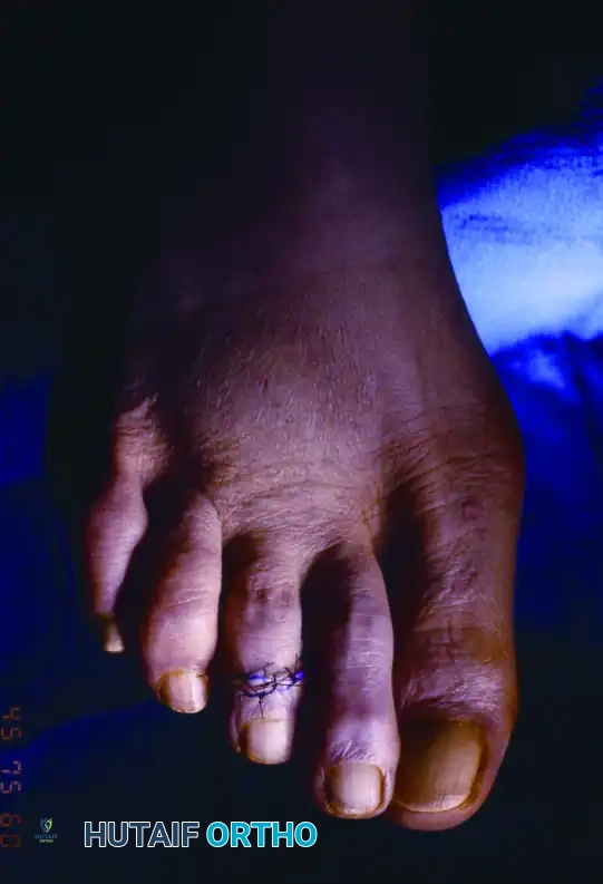 MALLET TOE Surgical Diagram